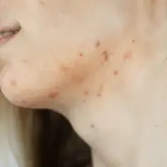 Masz pryszcze pod brodą? Jak pozbyć się ich raz na zawsze? Rady